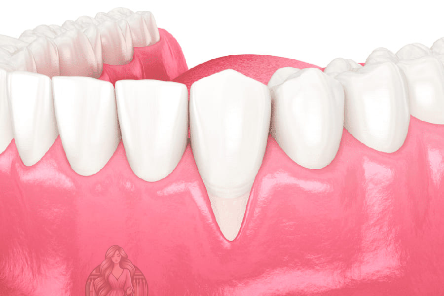 أسباب وعلاج نزول اللثة وتعري الأسنان