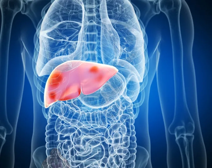 دراسة حديثة تحذر من تضاعف إصابات سرطان الكبد في العالم 2050